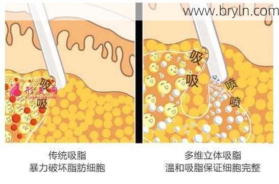 小腿抽脂多少钱(网红去世背后抽脂生意：腿部抽脂可达3万，“一天五到八台手术”)