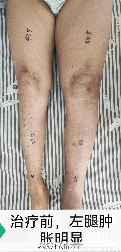 腿脚浮肿(老年人小腿和脚浮肿怎么办？严重吗？该怎么治疗？)