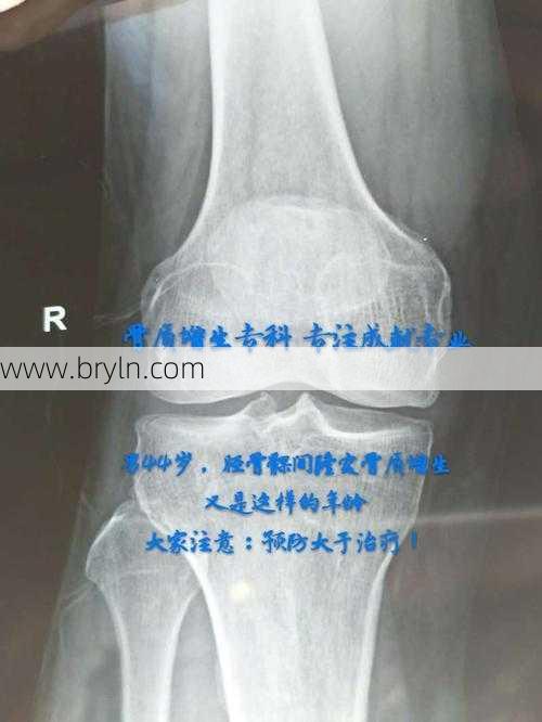 骨质增生会自愈吗？骨质增生的4大诱因要谨防