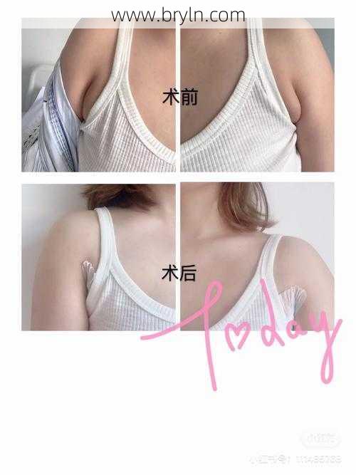 副乳切除(切除副乳后，需要多长时间恢复？还会复发吗？一次性给你讲清)