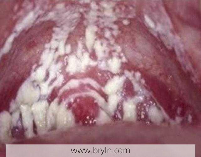霉菌感染症状()