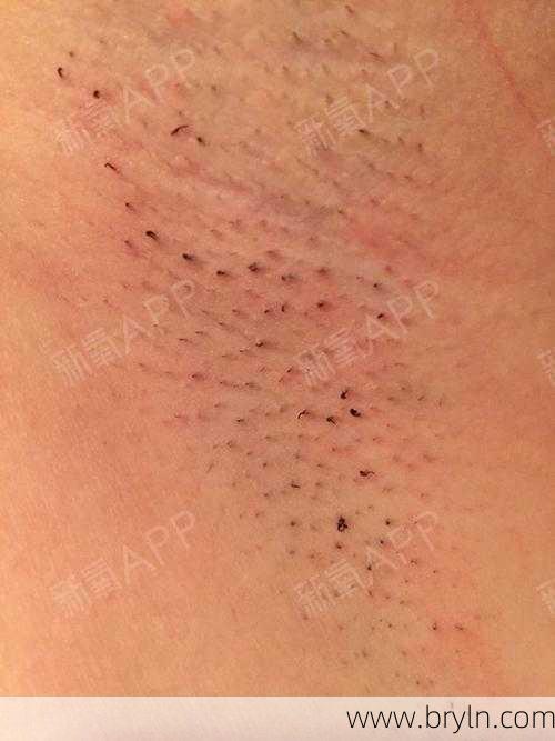 激光脱腋毛()
