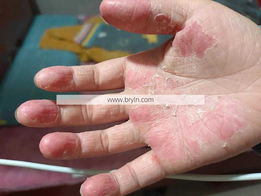 手脱皮缺什么(手脱皮是怎么回事？通常是缺乏这种维生素，补一补就好了)