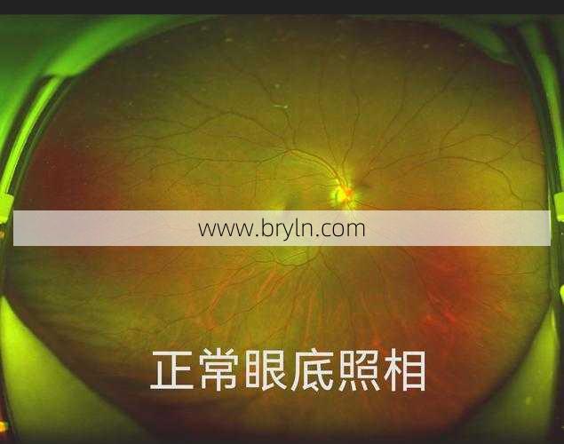 玻璃体后脱离是怎么回事