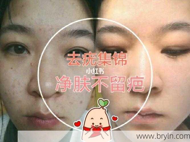 激光去疣体多少钱()