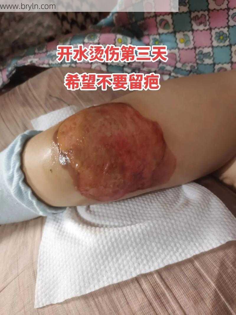 开水烫了怎么办()
