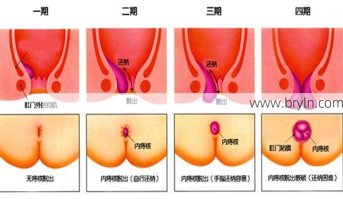 内痔疮的症状()