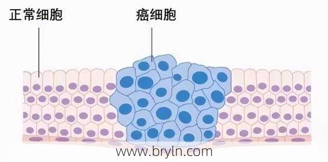 什么是癌细胞的分化，低分化癌是不是意味着更高的恶性程度