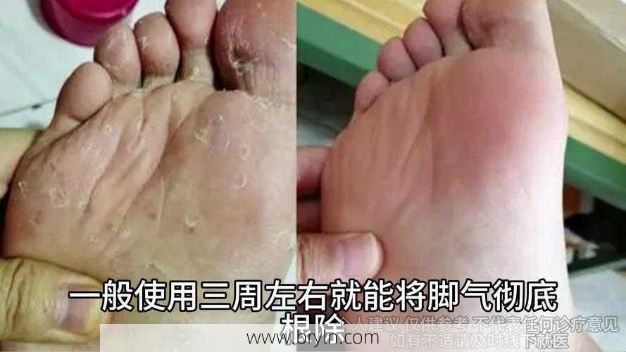 什么是脚气病？如何治疗？