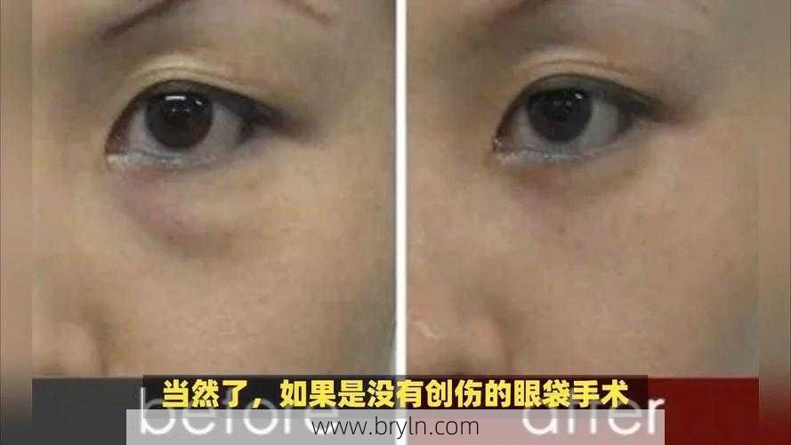 哪里能去眼袋(北京哪里去眼袋最好？我都做过两次去眼袋手术了不能再失败了)