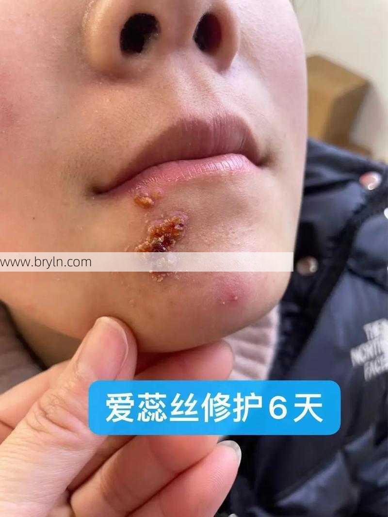 病毒性疱疹传染吗 病毒性疱疹怎么办