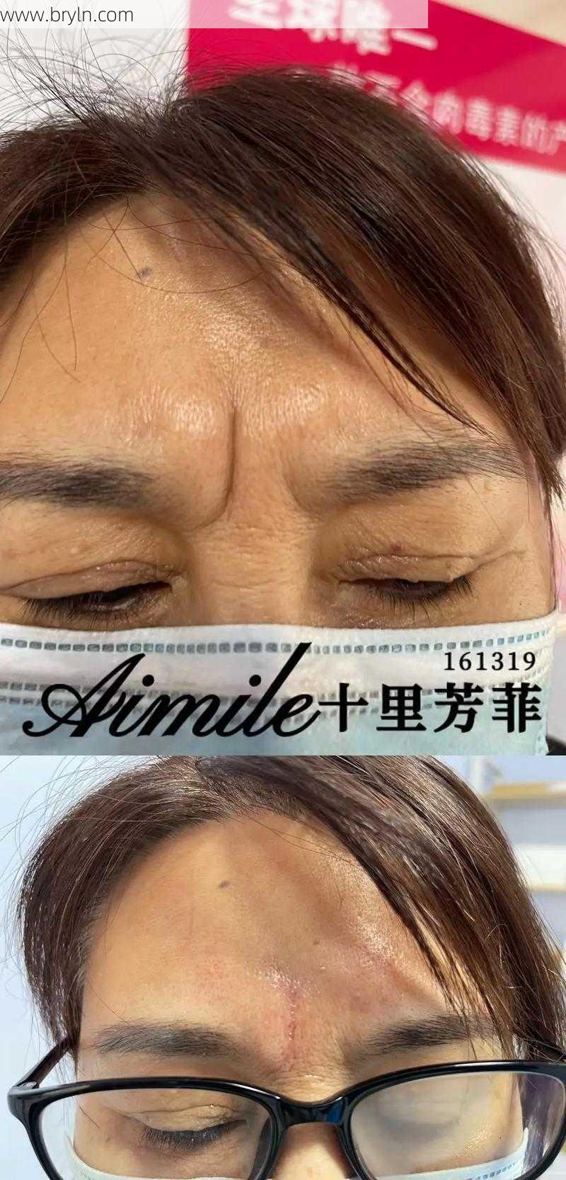 悬针纹怎么去除(九福师傅：可怕的悬针纹，血光之灾要注意！)
