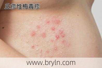 梅毒会痒吗(得了梅毒有什么症状？身上会痒吗？梅毒能治愈吗？医生为你科普)