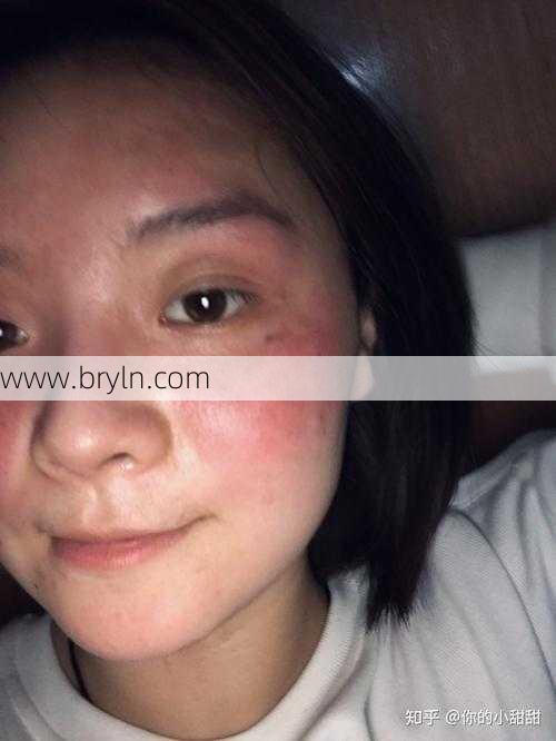 容易脸红怎么办