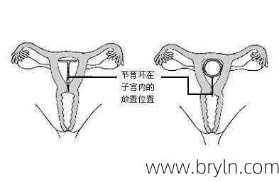 上环一般几年取环(上环取环全过程，让过来人告诉你，为什么80%的女人拒绝上环)