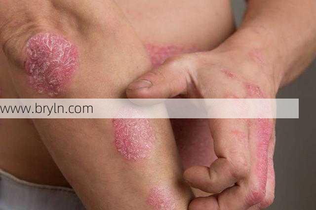银屑病能治好吗(不死的皮肤病 | 银屑病能被治愈吗？预防复发这6点是关键)