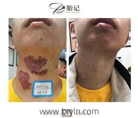 去胎记需要多少钱(商丘治胎记需要多少钱)